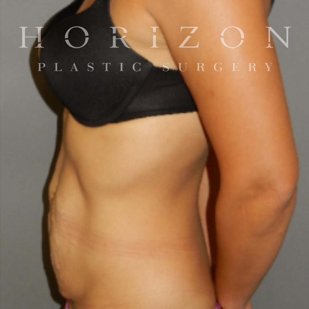 ABDOMINOPLASTY (Tummy Tuck) - Horizon Plastic Surgery Melbourne
