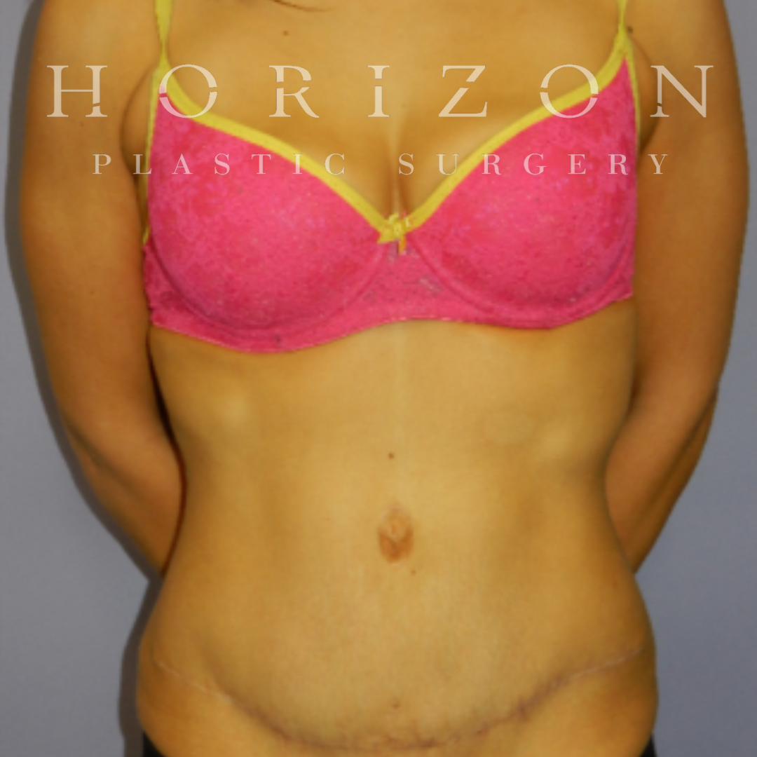 ABDOMINOPLASTY (Tummy Tuck) - Horizon Plastic Surgery Melbourne