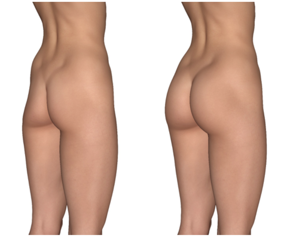 What is a BBL (Brazilian buttocks lift)? - Williams Center